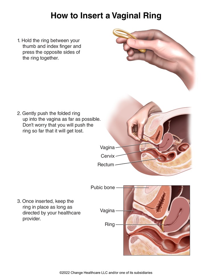 Vaginal Contraceptive Ring, How to Insert: Illustration