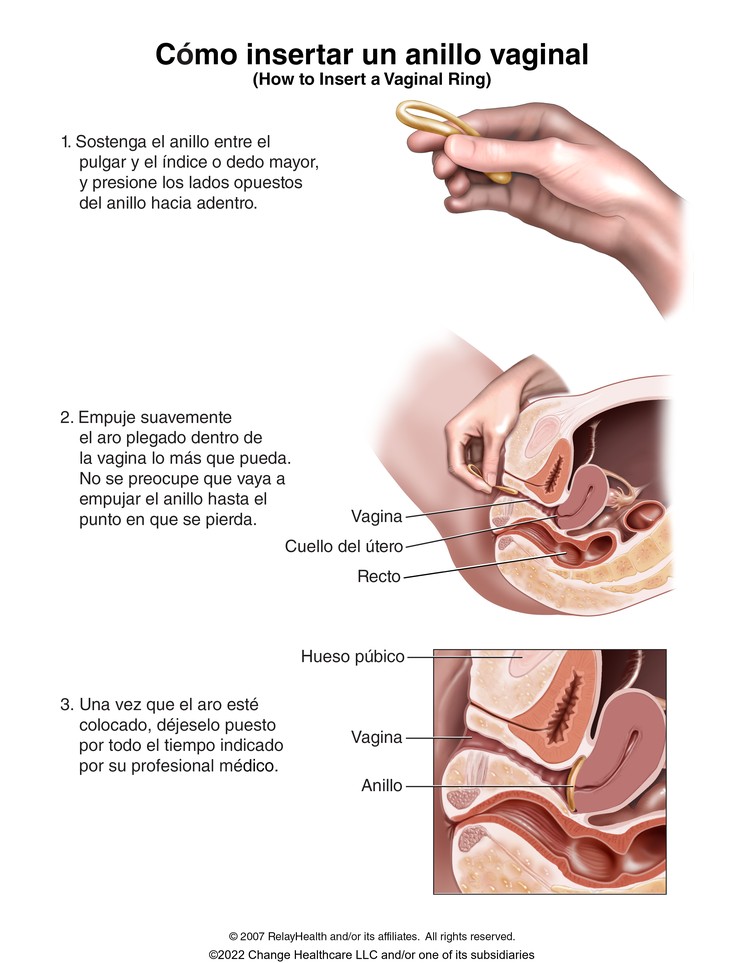 Vaginal Contraceptive Ring, How to Insert: Illustration