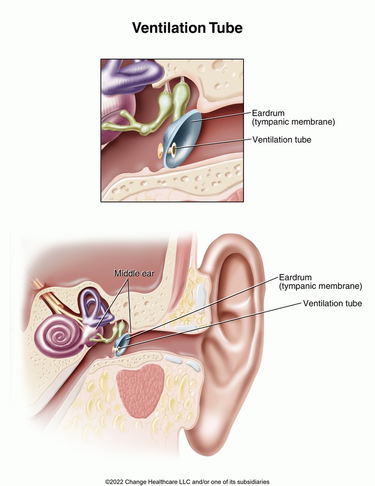 Ventilation Tube: Illustration