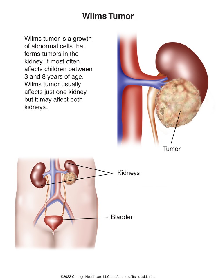 Wilms Tumor: Illustration