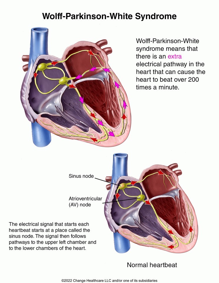 Wolff-Parkinson-White Syndrome: Illustration