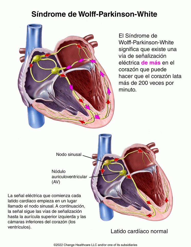 Wolff-Parkinson-White Syndrome: Illustration