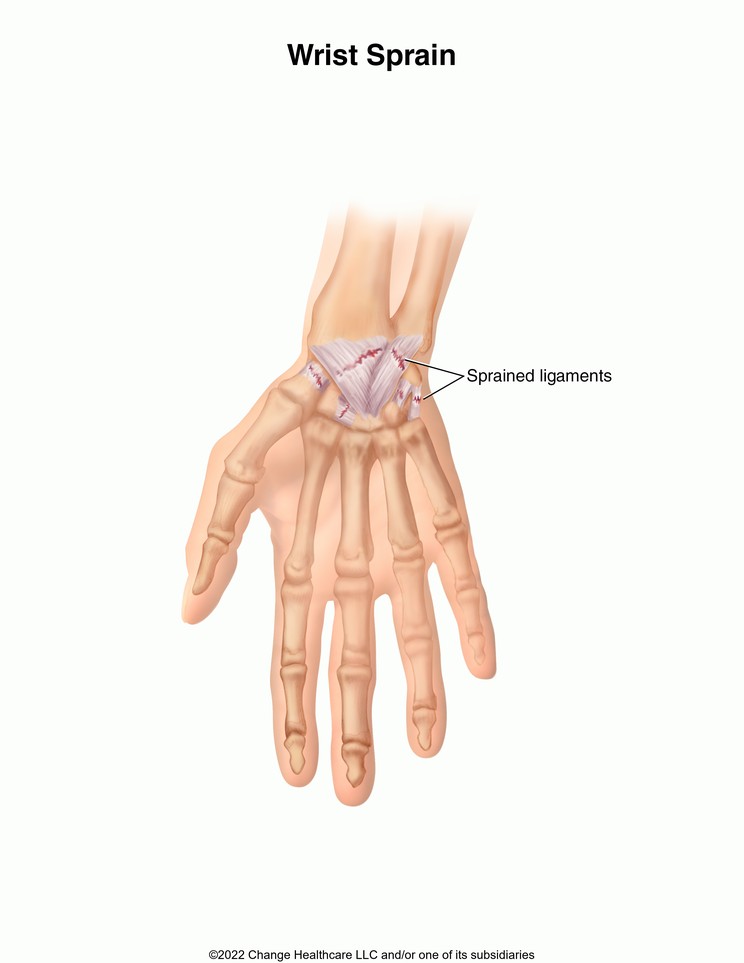 Wrist Sprain: Illustration