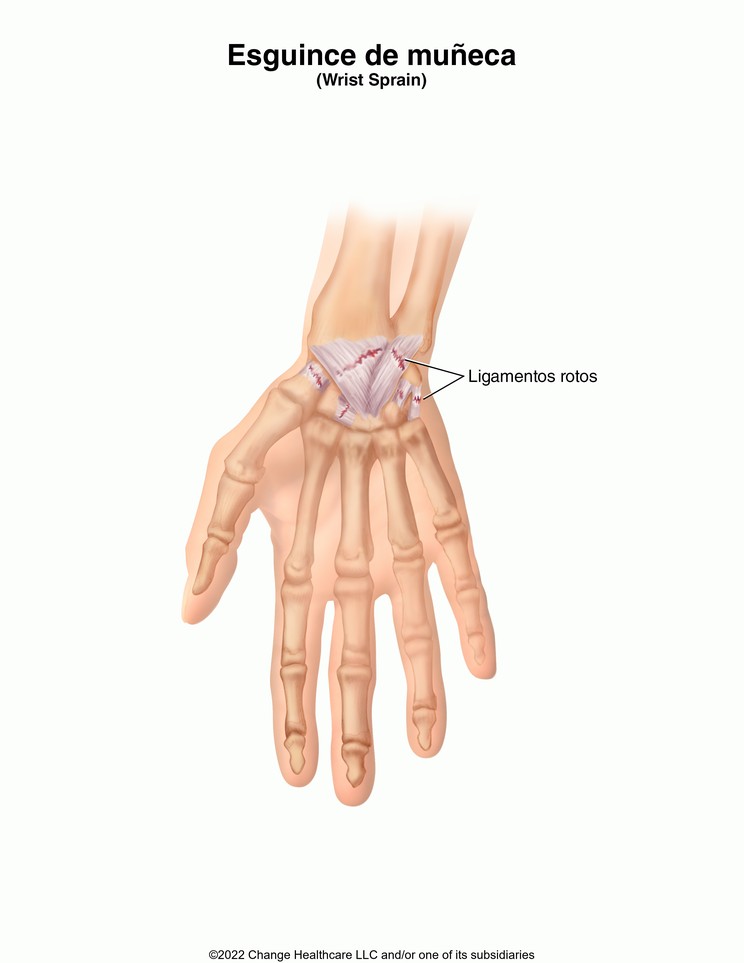 Wrist Sprain: Illustration