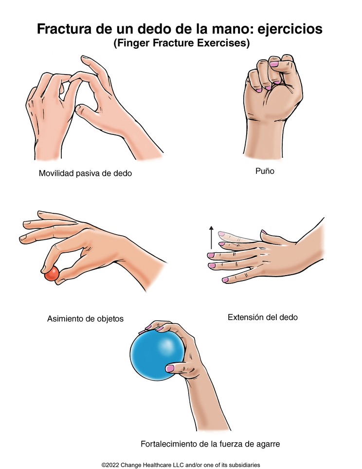 Finger Fracture Exercises: Illustration