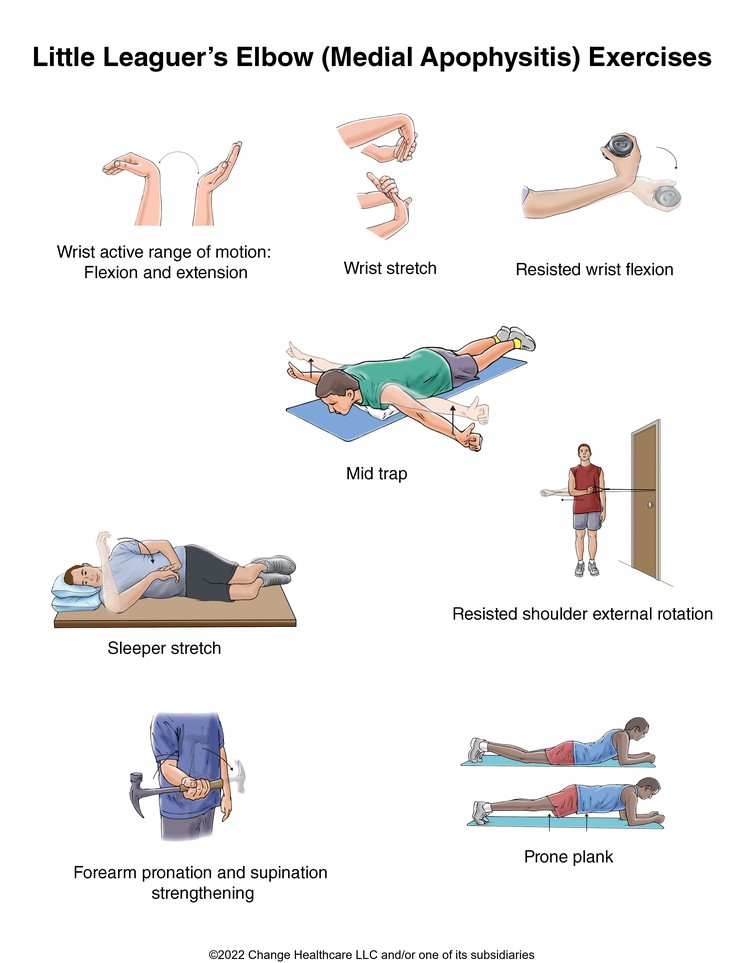 Little Leaguer's Elbow (Medial Apophysitis) Exercises: Illustration