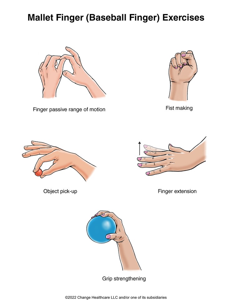 Mallet Finger (Baseball Finger) Exercises: Illustration