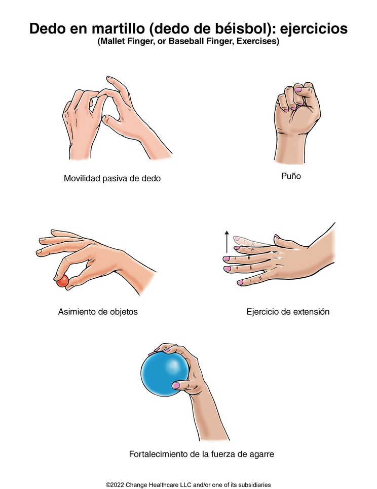 Mallet Finger (Baseball Finger) Exercises: Illustration