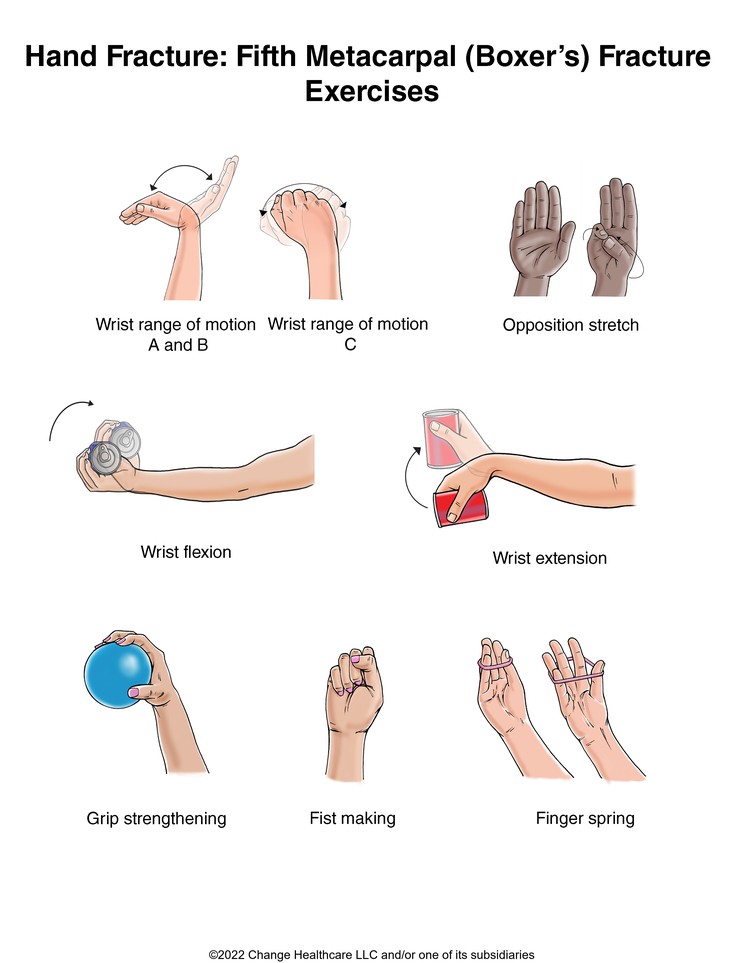 Hand Fracture: Fifth Metacarpal (Boxer's) Fracture Exercises: Illustration