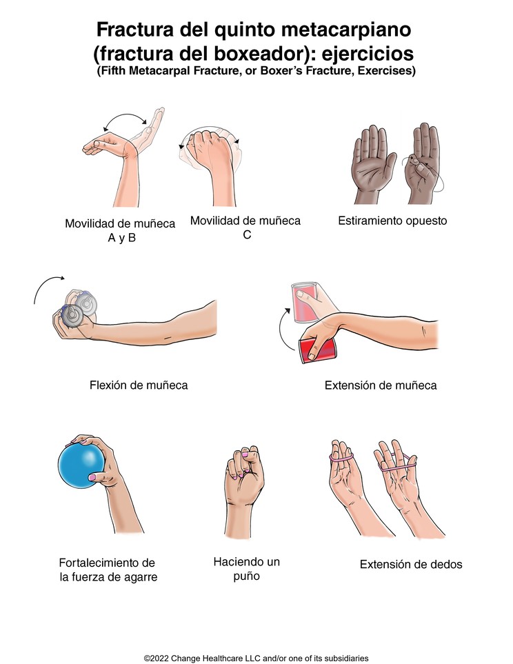 Hand Fracture: Fifth Metacarpal (Boxer's) Fracture Exercises: Illustration