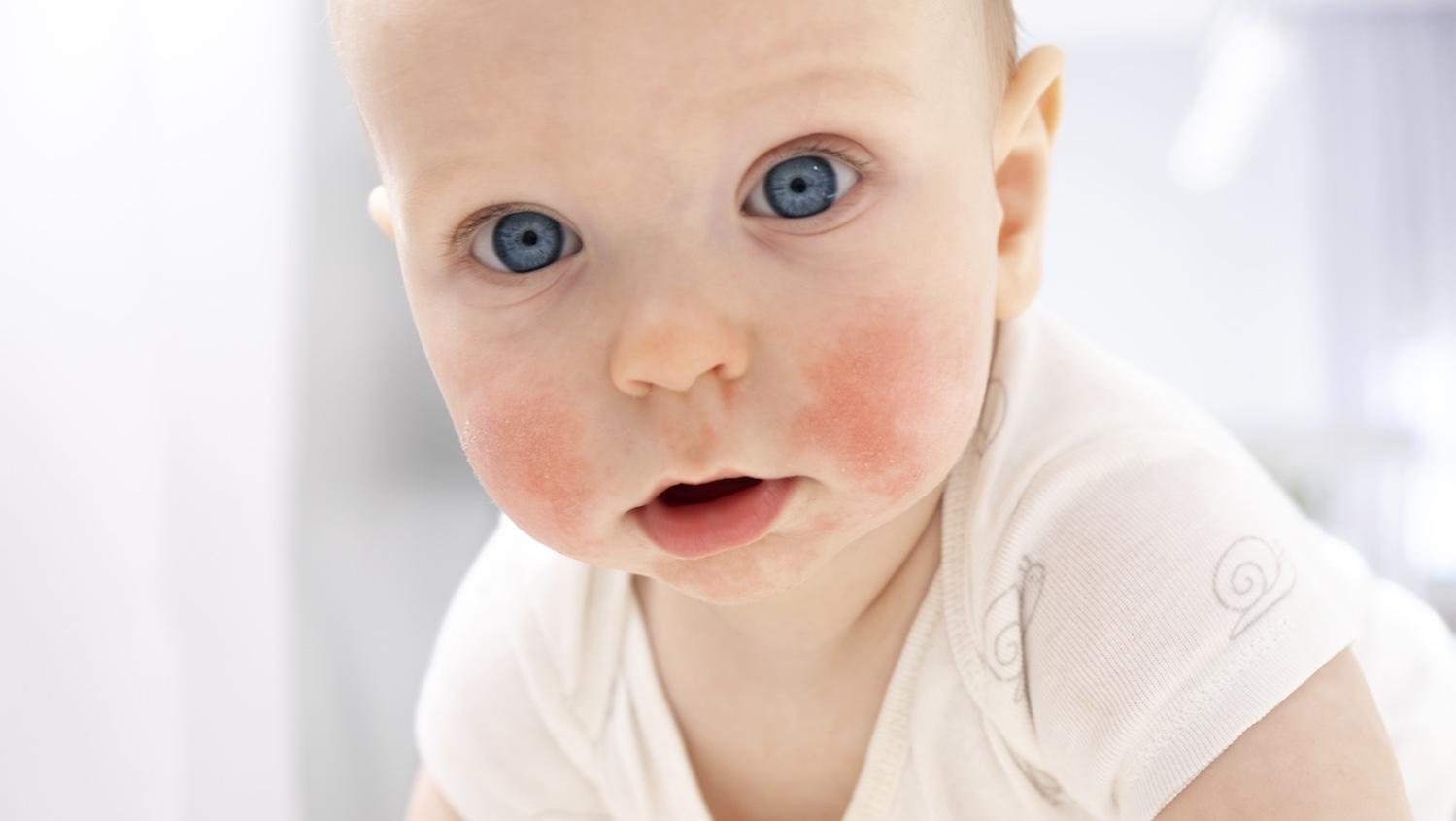 Fifth Disease