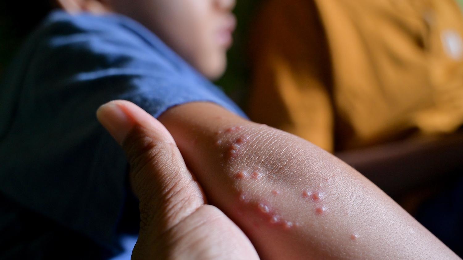 Molluscum Contagiosum