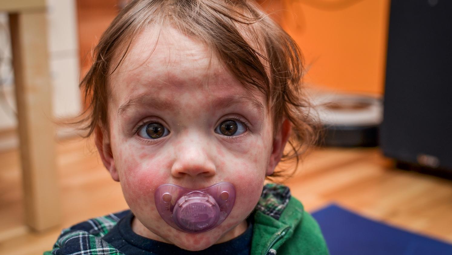 Roseola