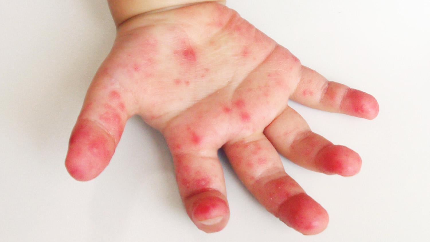 Summertime Infections